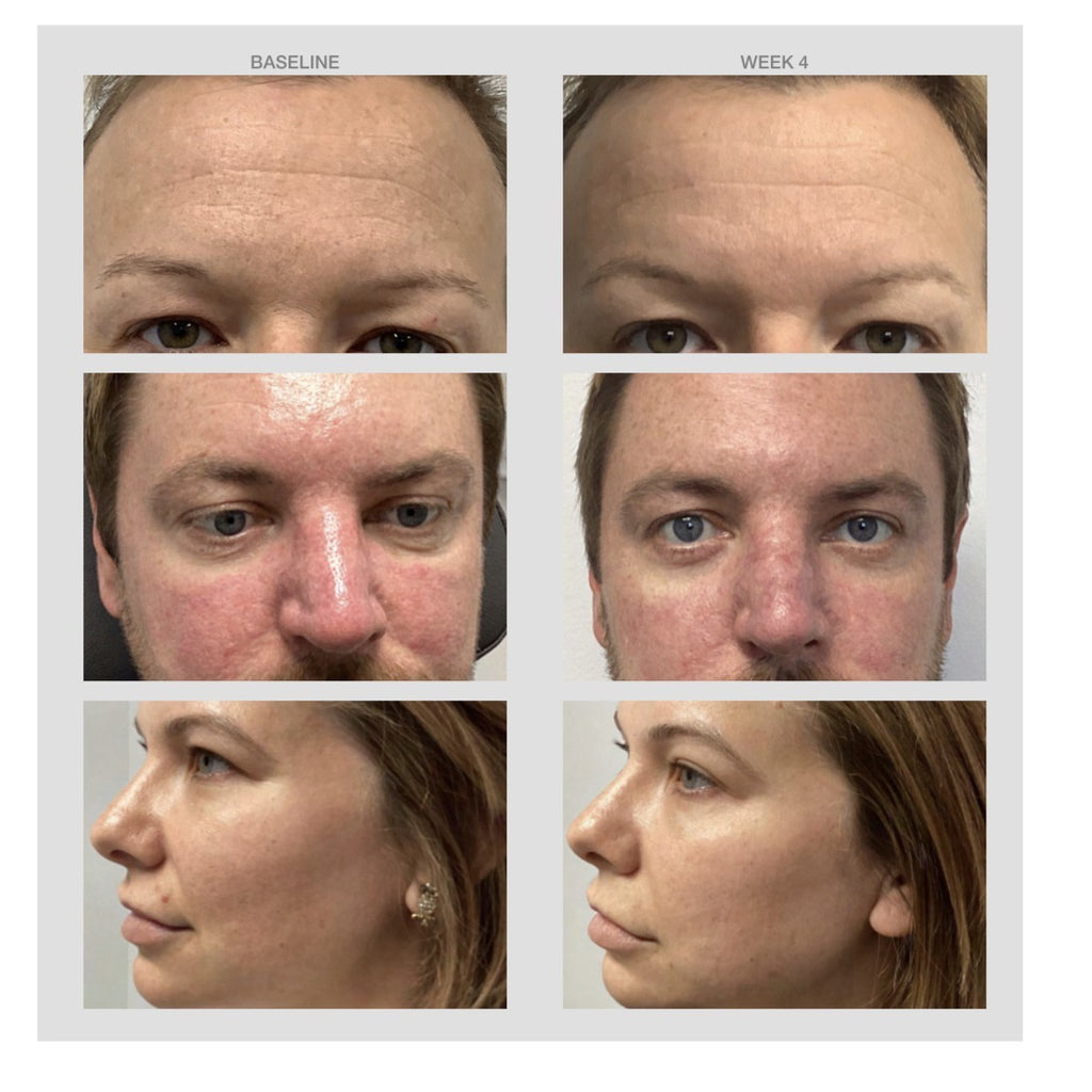 Niacinamide Discoloration Serum results: baseline and week 4