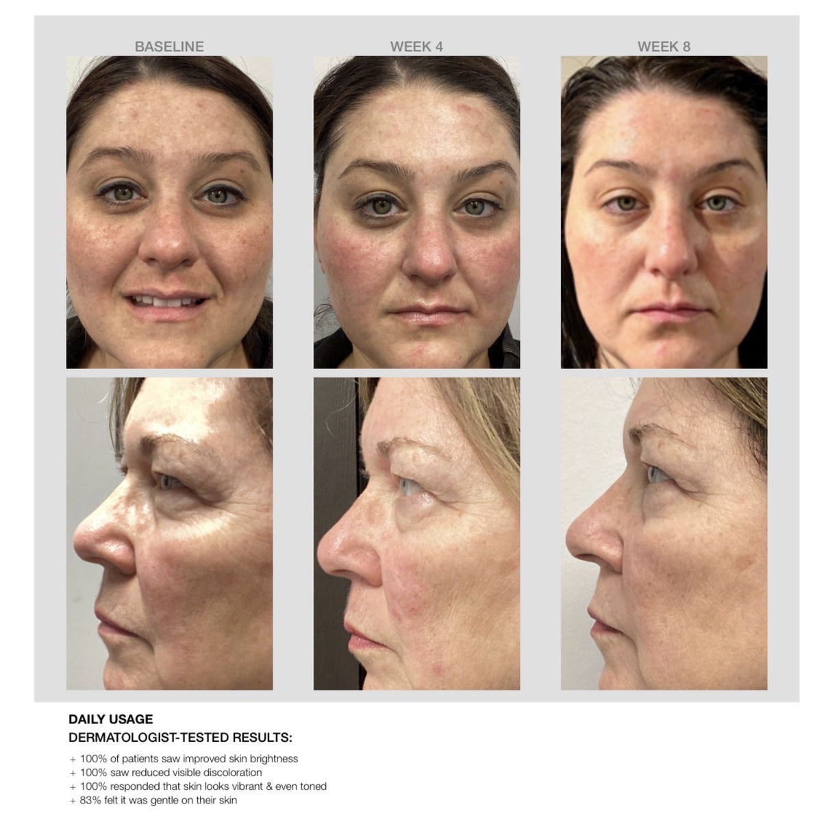 Niacinamide Discoloration Serum results: baseline, week 4 and week 8, with dermatologist-tested results