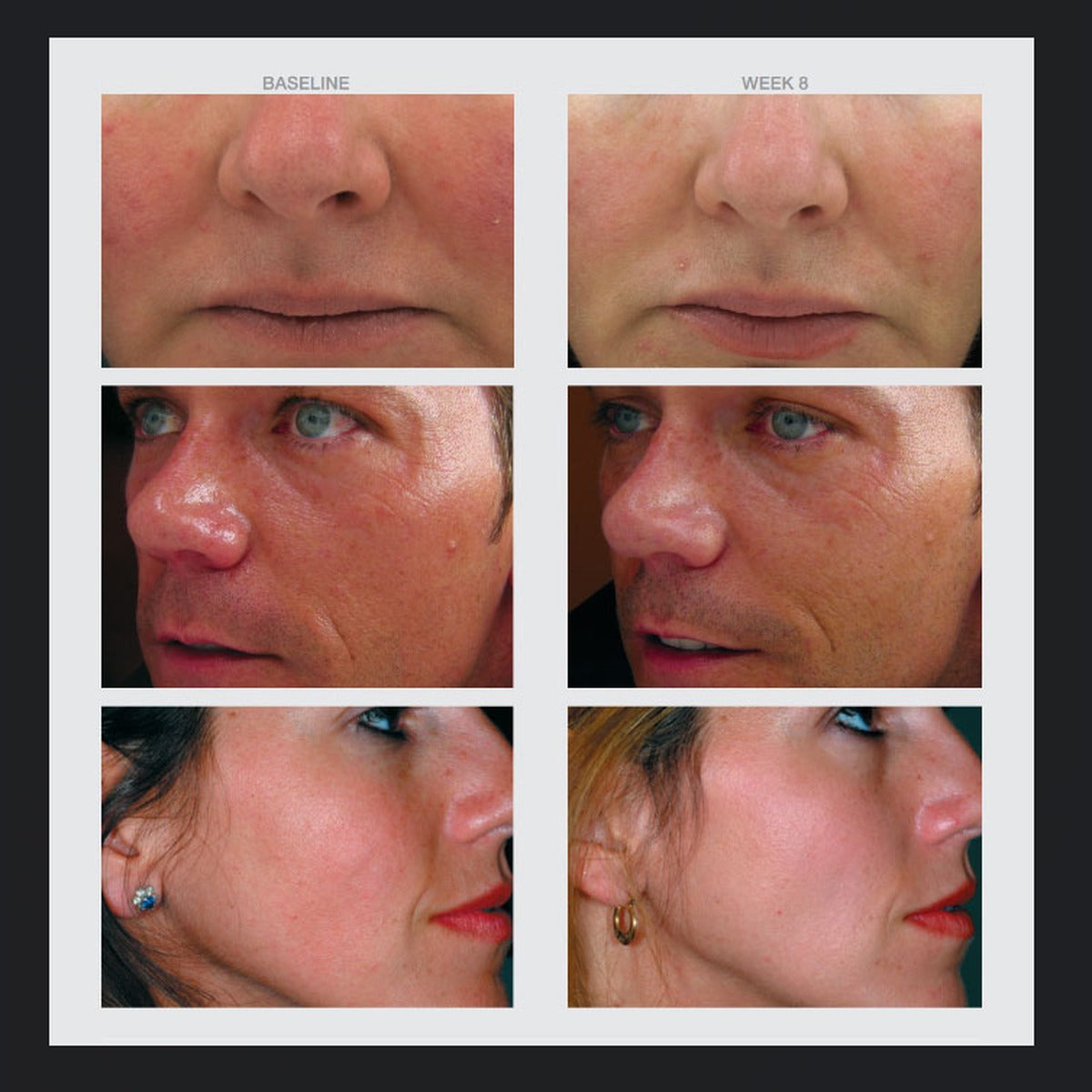 Redness Calming Creme results: three people's skin at baseline and at week 8