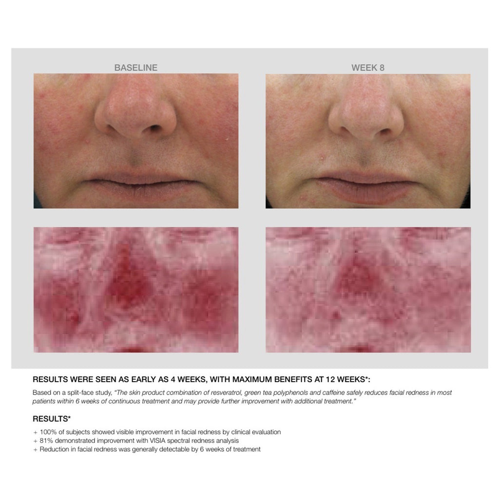 Redness Calming Creme split-face study: baseline and week 8 with redness analysis and results