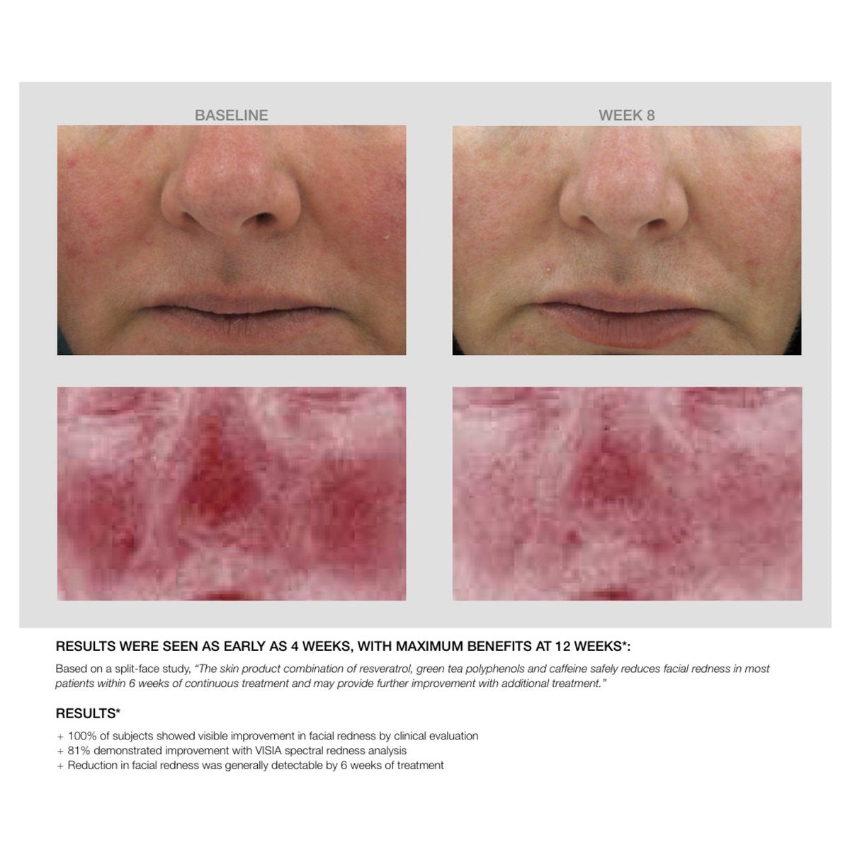 Redness Calming Creme split-face study: baseline and week 8 with redness analysis and results