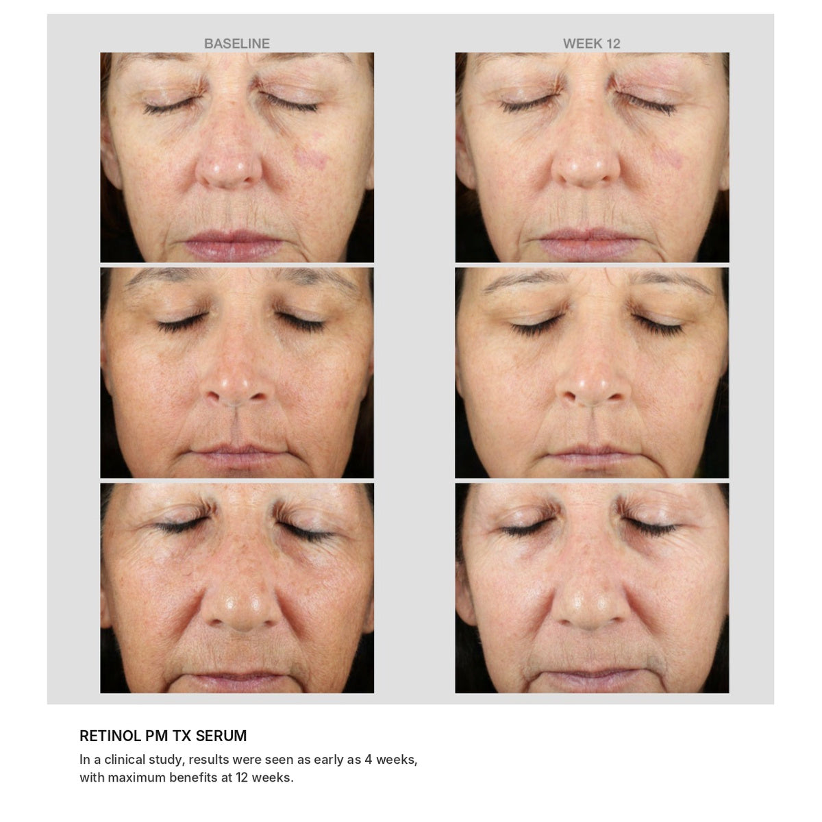 Retinol PM TX Serum results: baseline and week 12. In a clinical study, results were seen as early as 4 weeks, with maximum benefits at 12 weeks.